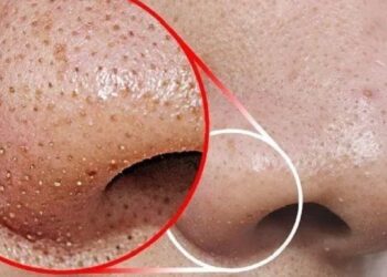 Chất trắng tiết ra khi bạn nặn mụn trên mũi là gì? Làm thế nào để loại bỏ chúng?