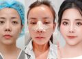 Cô gái 9x đi phẫu thuật toàn bộ gương mặt, ngỡ ngàng nhan sắc sau khi dao kéo