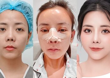 Cô gái 9x đi phẫu thuật toàn bộ gương mặt, ngỡ ngàng nhan sắc sau khi dao kéo