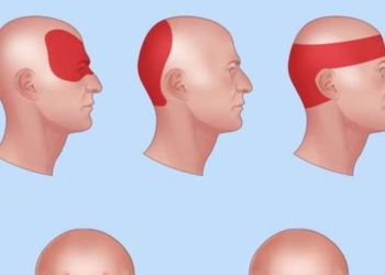 Làm thế nào để giúp ngăn chặn cơn đau đầu