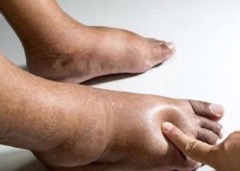 Nghẽn mạch máu, bàn chân tiên tri, bất kể nam hay nữ, 4 triệu chứng này xuất hiện ở bàn chân hãy kiểm tra càng sớm càng tốt