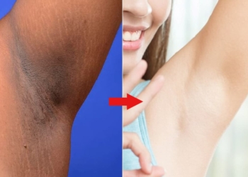 Đánh bay vết thâm trên da nhờ 4 phương pháp đơn giản mà không hề tốn tiền