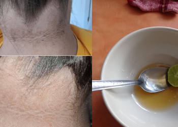4 biện pháp khắc phục tại nhà để làm mờ vết thâm trên da mà không tốn nhiều tiền